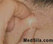 Диагностика липомы